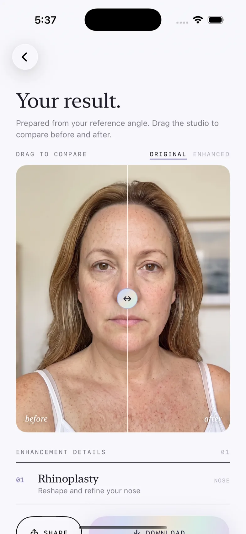 Mevona — résultat avant/après d'une rhinoplastie simulée